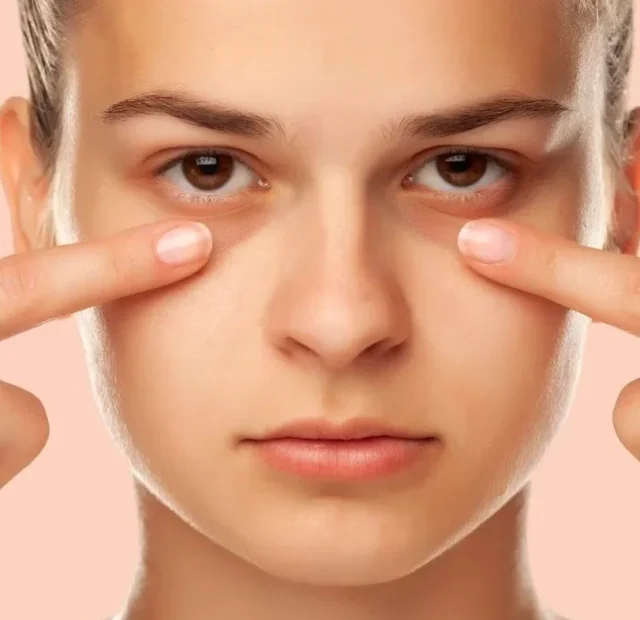 Dark circles under the eyes are common. Here's how to get rid of them (4)