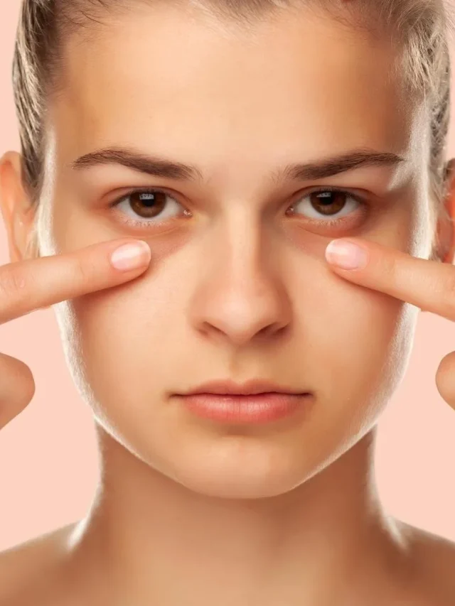 Dark circles under the eyes are common. Here’s how to get rid of them